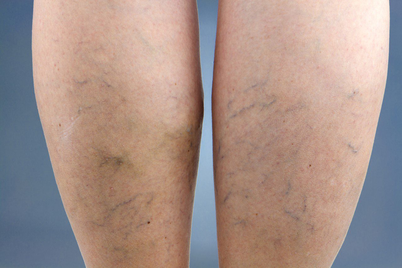 Varicose veins on back of leg.